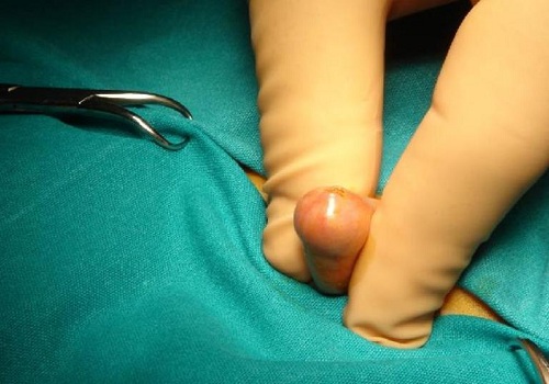 Sưng bao quy đầu ở nam giới là bệnh gì? Cách chữa trị nhanh