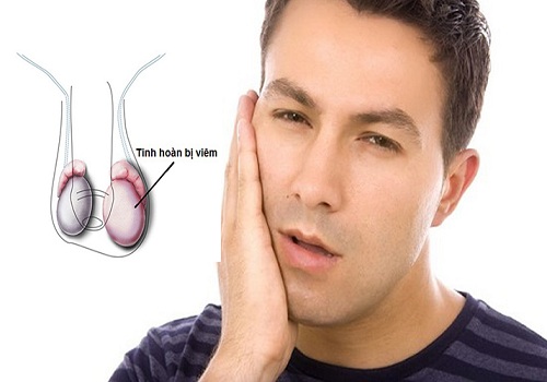 Cách điều trị viêm tinh hoàn sau quai bị an toàn hiệu quả