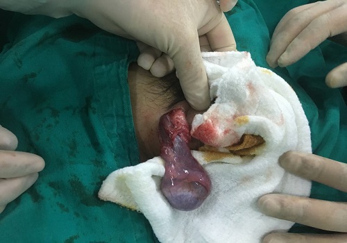 Biến chứng viêm tinh hoàn bệnh quai bị - nam giới nên biết