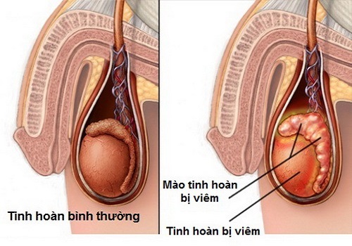 Biến chứng viêm tinh hoàn bệnh quai bị - nam giới nên biết
