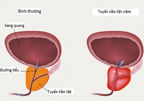 Tinh trùng có màu vàng nhạt vón cục có làm sao không?