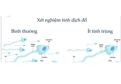 Cách điều trị bệnh tinh trùng yếu - Phòng khám Kiến Quốc
