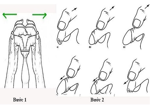 Cách lột bao quy đầu tại nhà và một số cảnh báo nguy hiểm