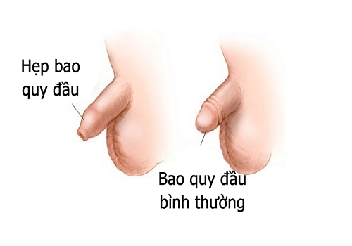 Tại sao lại bị hẹp bao quy đầu? Chuyên gia giải đáp