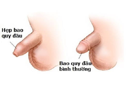 Cắt hẹp bao quy đầu ở đâu? Địa chỉ uy tín tại An Giang