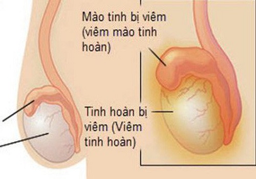 Triệu chứng viêm tinh hoàn ở nam giới cần biết sớm