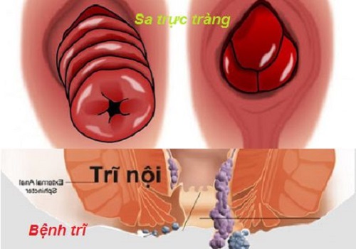 Tìm hiểu về trĩ - bệnh hậu môn trực tràng nguy hiểm hiện nay