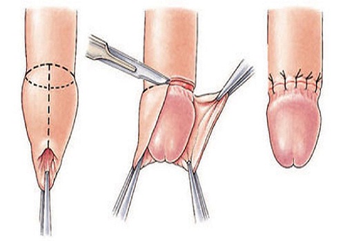 Điều trị hẹp bao quy đầu hiệu quả