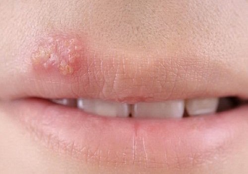 Hình ảnh mụn rộp sinh dục nam giới