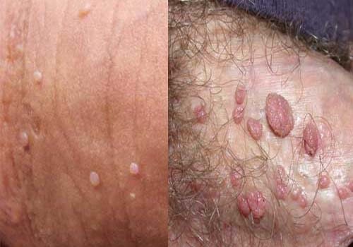 Cách chữa/điều trị mụn cóc ở nam giới hiệu quả