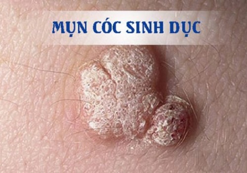 Cách chữa/điều trị mụn cóc ở nam giới hiệu quả