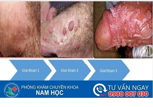 Cách chữa/điều trị mụn cóc ở nam giới hiệu quả