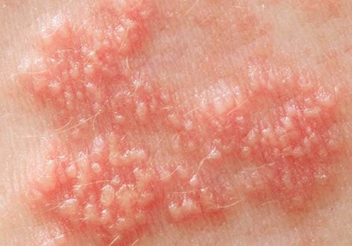 Mụn rộp ở người nhiễm HIV như thế nào? Chia sẻ từ chuyên gia