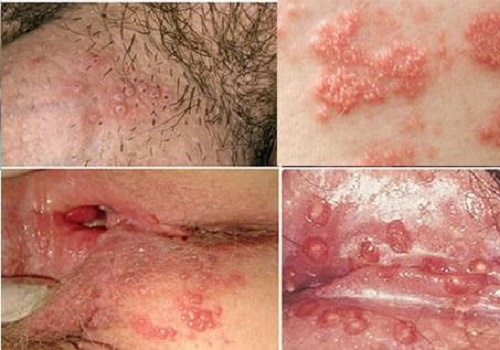 Mụn rộp ở người nhiễm HIV như thế nào? Chia sẻ từ chuyên gia