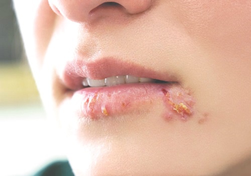 Bệnh herpes là gì? Virus gây bệnh là gì? Xét nghiệm bệnh như thế nào?