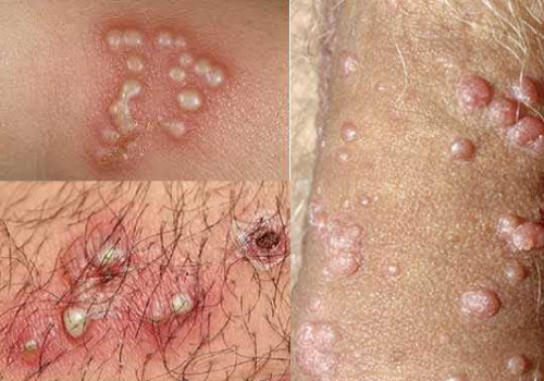 Bệnh herpes là gì? Virus gây bệnh là gì? Xét nghiệm bệnh như thế nào?