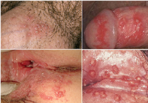 Bệnh herpes là gì? Virus gây bệnh là gì? Xét nghiệm bệnh như thế nào?