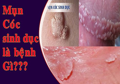 Mụn cóc sinh dục: nam giới dấu hiệu, triệu chứng, biểu hiện và cách chữa trị hiệu quả