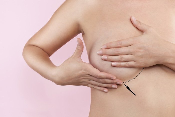 Ngực 'quả mướp' và những lầm tưởng của hầu hết mọi người - 1