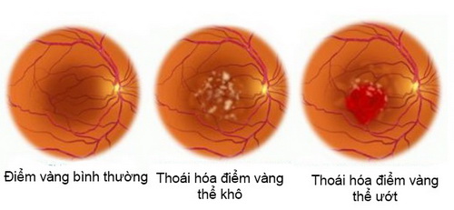 Thoái hóa hoàng điểm tuổi già là nguyên nhân phổ biến nhất của giảm thị lực.