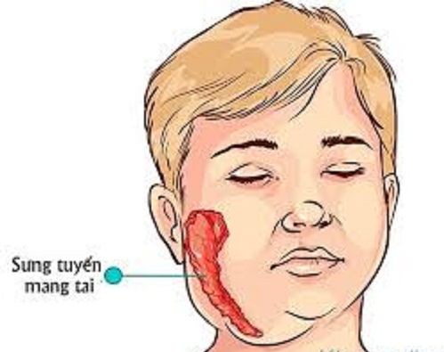 Cẩn thận khi sưng tuyến nước bọt mang tai