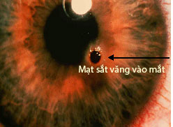 Xử trí cấp cứu chấn thương mắt