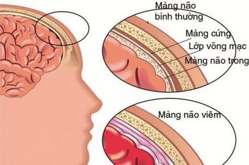 Hình ảnh viêm màng não.