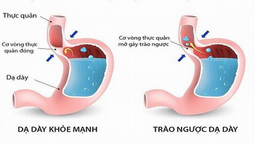 Hội chứng trào ngược dạ dày.