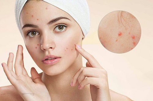 Mụn trứng cá là gì?