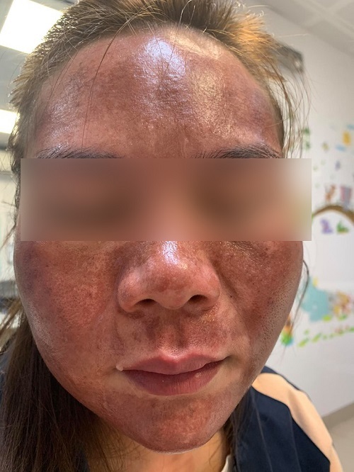 Bỏng khắp mặt do dùng mỹ phẩm lột mụn và nám