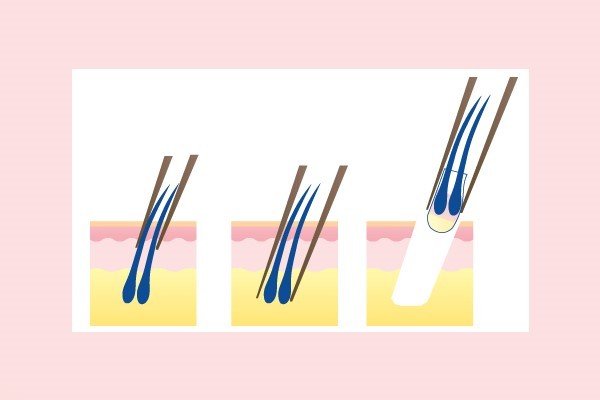 Sự thật về phương pháp cấy tóc được ví như 'đũa thần' chữa hói đầu
