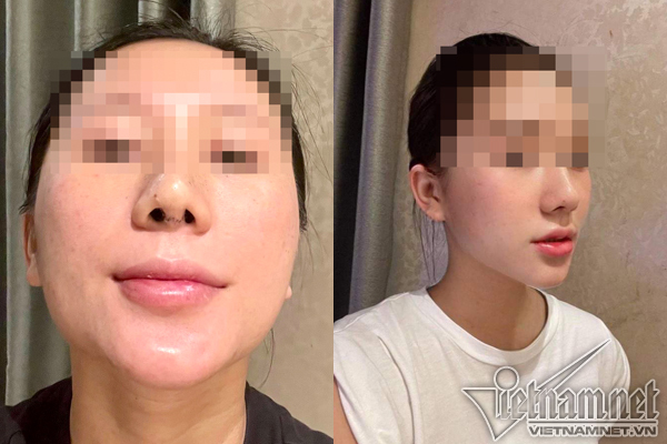 Bác sĩ cắt sụn sườn nâng mũi vẹo cho cô gái Hà Nội