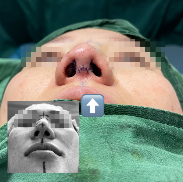 Bác sĩ cắt sụn sườn nâng mũi vẹo cho cô gái Hà Nội