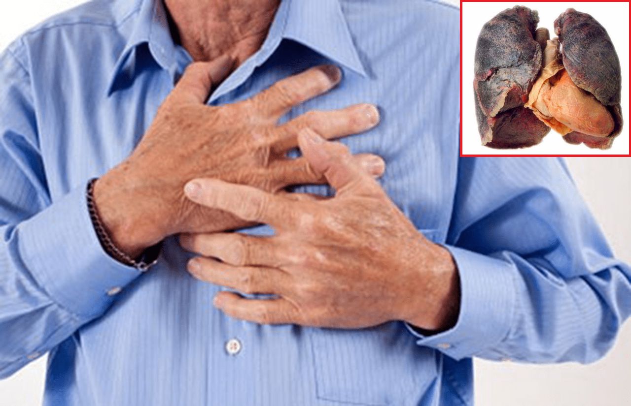 Ho ra máu tươi, cụ ông đi khám phát hiện ung thư phổi giai đoạn cuối - 1