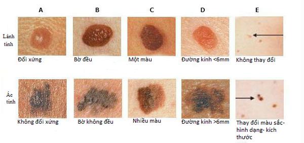 Dấu hiệu nhận biết sớm nốt ruồi ác tính - 1