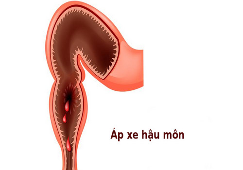 Áp xe hậu môn: Dấu hiệu, triệu chứng, biểu hiện và cách chữa trị hiệu quả - Phòng Khám Đa Khoa An Giang