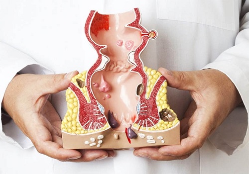 Người bị bệnh trĩ ngoại nên ăn gì và kiêng gì? - Phòng Khám Đa Khoa An Giang