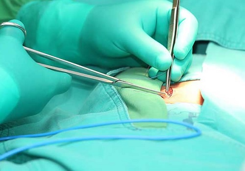 Phẫu thuật rò hậu môn nên tiến hành khi nào?
