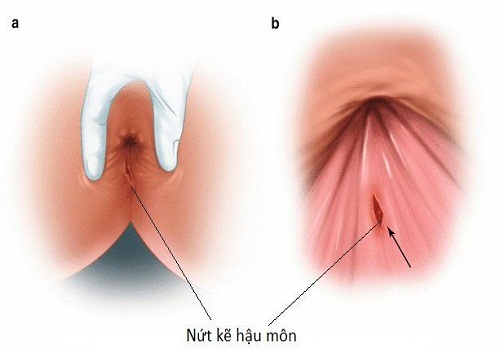 Đi ngoài ra máu là dấu hiệu gì? Có cần đi thăm khám