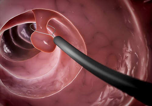 Khi nào nên cắt polyp hậu môn - nắm rõ để điều trị