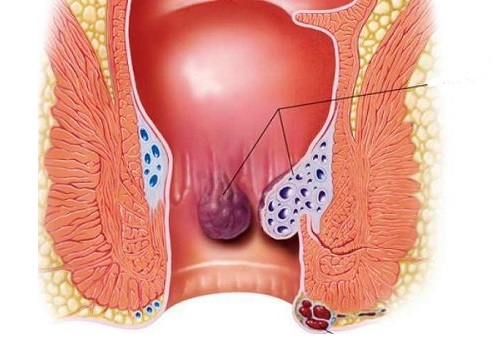 Khi nào nên cắt polyp hậu môn - nắm rõ để điều trị