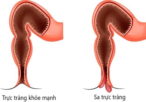 Tác hại bệnh polyp hậu môn mọi người cần chú ý