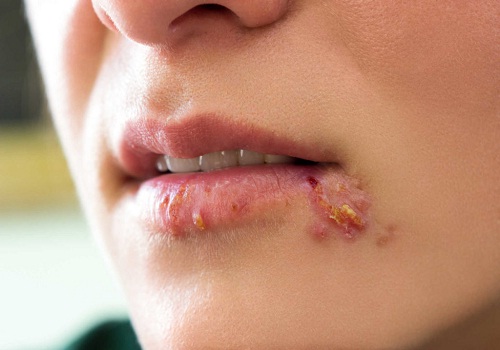 Triệu chứng của bệnh herpes sinh dục ở nam và nữ