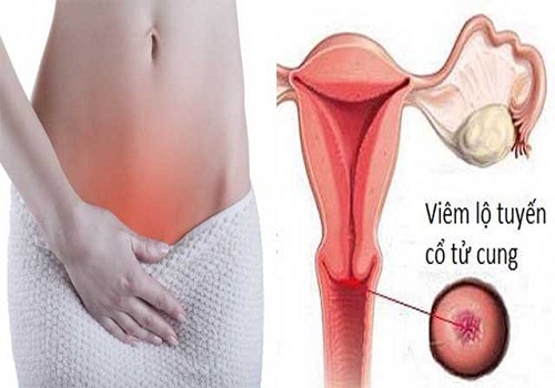 Viêm lộ tuyến cổ tử cung 1.5cm là gì? Có nguy hiểm không?