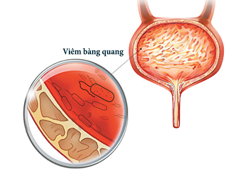 Viêm bàng quang cấp là gì? Có nguy hiểm hay không?
