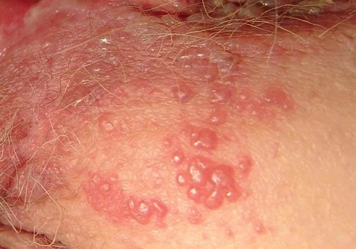 Mụn rộp sinh dục ở nam giới có nguy hiểm không? Cách chữa trị