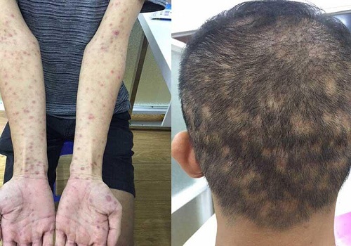 Bệnh lây nhiễm qua đường tình dục mà nam giới dễ mắc phải