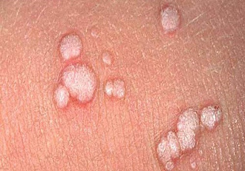 Phân biệt mụn rộp sinh dục và sùi mào gà như thế nào?