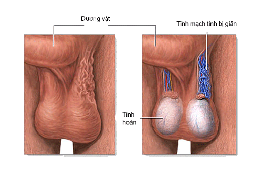 Chữa/điều trị giãn tĩnh mạch thừng tinh bằng đông y có được không?