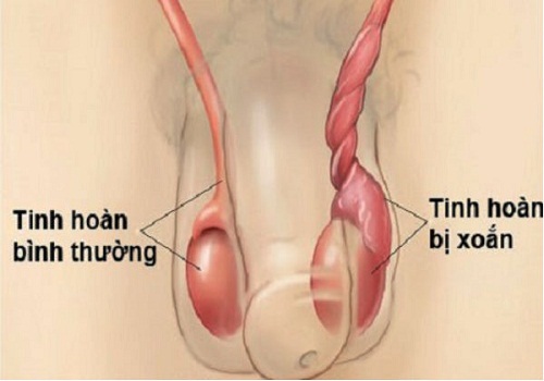 Nguyên nhân dẫn đến teo tinh hoàn ở nam giới là gì?